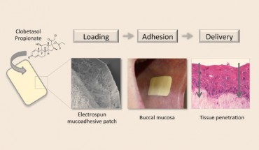 The new patch administers steroids directly to oral ulcers and forms a protective barrier. Image credit: Colley et al, doi: 10.1016/j.biomaterials.2018.06.009.