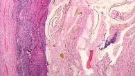 In the cohort study of 605 children undergoing appendectomy, those with IgE-mediated allergy had a 3 times lower risk of complicated appendicitis compared with those without allergy. This low magnification micrograph shows acute appendicitis and periappendicitis. Image credit: Michael Bonert / CC BY-SA 3.0.