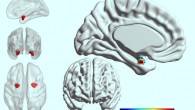 In people with bipolar disorder, the left side of the amygdala is less active and less connected with other parts of the brain than in people with depression. Image credit: Westmead Institute for Medical Research.