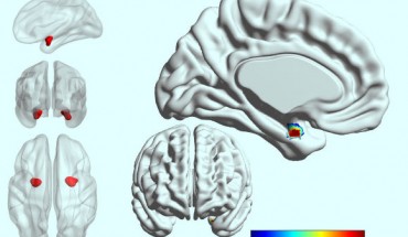In people with bipolar disorder, the left side of the amygdala is less active and less connected with other parts of the brain than in people with depression. Image credit: Westmead Institute for Medical Research.