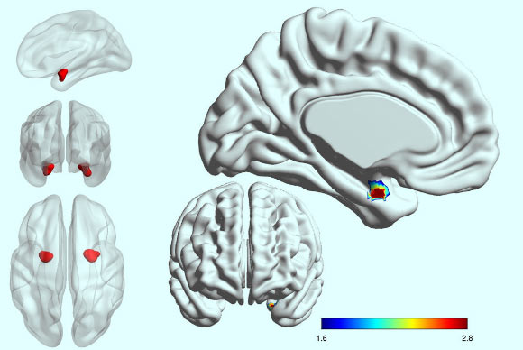 In people with bipolar disorder, the left side of the amygdala is less active and less connected with other parts of the brain than in people with depression. Image credit: Westmead Institute for Medical Research.