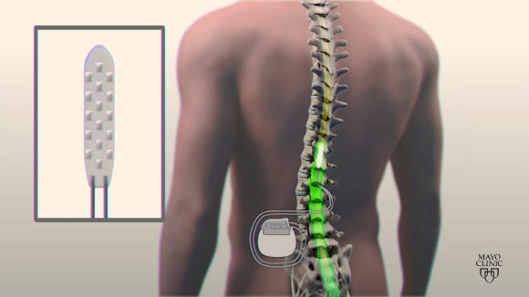 A spinal cord stimulator. Image credit: Mayo Clinic.