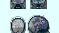Brain areas reflecting choice set value: areas shown in red to yellow exhibit a linear increase in fMRI activity as a function of S during the exposure stage of the pooled choice trials. Image credit: Reutskaja et al, doi: 10.1038/s41562-018-0440-2.