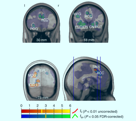 Brain areas reflecting choice set value: areas shown in red to yellow exhibit a linear increase in fMRI activity as a function of S during the exposure stage of the pooled choice trials. Image credit: Reutskaja et al, doi: 10.1038/s41562-018-0440-2.