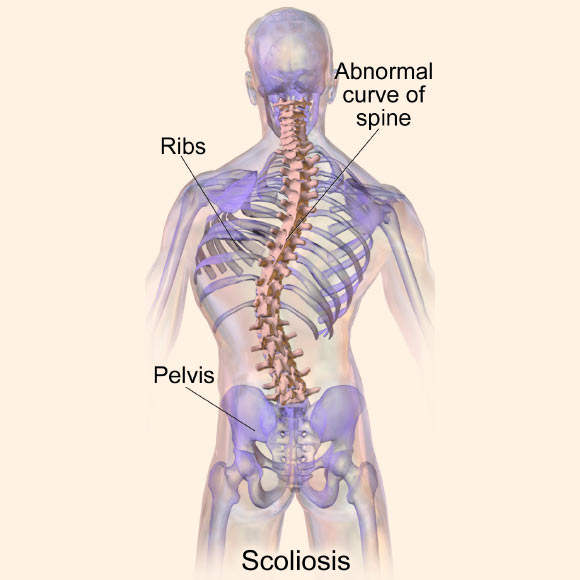 Haller et al suggest that the body’s inability to fully utilize manganese might be to blame for some cases of severe scoliosis. Image credit: Blausen.com, doi: 10.15347/wjm/2014.010.