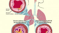 Asthma sufferers have trouble breathing because of the narrowing of the airways in their lungs, an example of which is shown in the upper left. In chronic asthma (lower left), repeated cycles of inflammation, damage, and repair lead to airway remodeling and fibrosis, the buildup of collagen and other materials. A signaling molecule known as NF-κB can significantly reduce chronic asthma (lower right). Image credit: National Institute of Allergy and Infectious Diseases.