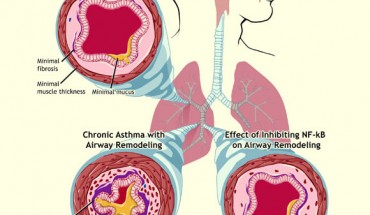 Asthma sufferers have trouble breathing because of the narrowing of the airways in their lungs, an example of which is shown in the upper left. In chronic asthma (lower left), repeated cycles of inflammation, damage, and repair lead to airway remodeling and fibrosis, the buildup of collagen and other materials. A signaling molecule known as NF-κB can significantly reduce chronic asthma (lower right). Image credit: National Institute of Allergy and Infectious Diseases.