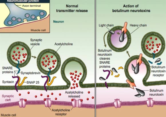 Mechanism of action of botulinum toxin: the light chain of (BT-A) cleaves SNAP-25 (synaptosome-associated protein of 25 KDa) and consequently prevents the release of acetylcholine into the neuromuscular junction. Image credit: Ali S. Al-Ghamdi et al, doi: 10.1016/j.jdds.2014.06.002.