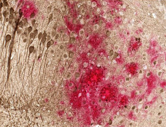 Toxic amyloid plaques (red) and tau tangles (brown) form on the brain of a mouse modeled to have Alzheimer’s disease. Image credit: University of Texas Southwestern.