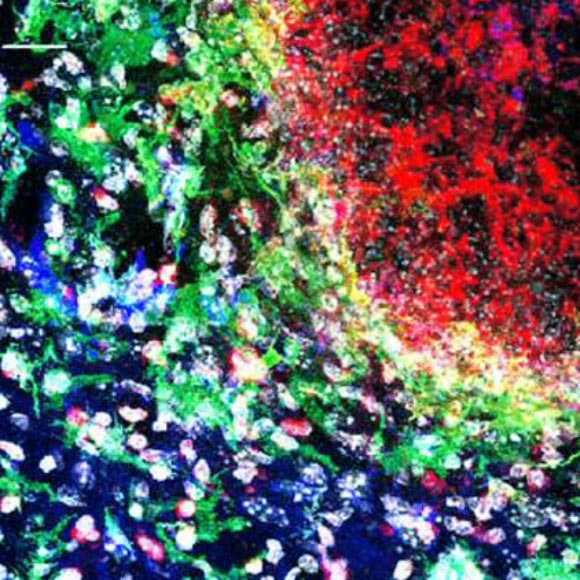 Wild-type mice were challenged with Candida albicans and immunofluorescence staining for DAPI, IBA1, Aβ, and GFAP was performed on brain sections containing fungal granulomas. Image credit: Wu et al, doi: 10.1038/s41467-018-07991-4.