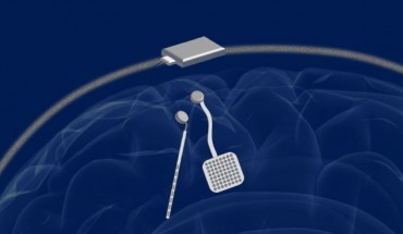 In a proposed neuromodulation device, two of the new chips would be embedded in a chassis located outside the head. Each chip could monitor electrical activity from 64 electrodes located into the brain while simultaneously delivering electrical stimulation to prevent unwanted seizures or tremors. Image credit: Rikky Muller / University of California, Berkeley.