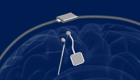 In a proposed neuromodulation device, two of the new chips would be embedded in a chassis located outside the head. Each chip could monitor electrical activity from 64 electrodes located into the brain while simultaneously delivering electrical stimulation to prevent unwanted seizures or tremors. Image credit: Rikky Muller / University of California, Berkeley.