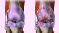 Knee osteoarthritis, also known as degenerative joint disease, is typically the result of wear and tear and progressive loss of articular cartilage. Image credit: Bruce Blaus / CC BY-SA 4.0.