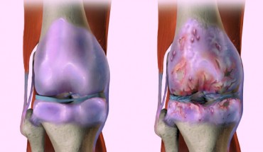 Knee osteoarthritis, also known as degenerative joint disease, is typically the result of wear and tear and progressive loss of articular cartilage. Image credit: Bruce Blaus / CC BY-SA 4.0.