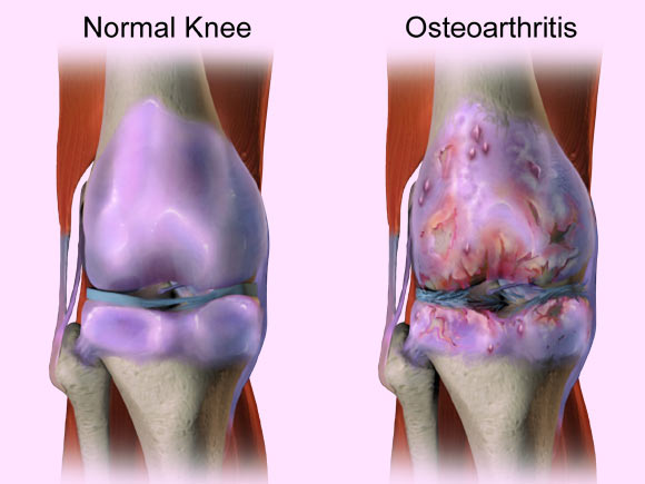 Knee osteoarthritis, also known as degenerative joint disease, is typically the result of wear and tear and progressive loss of articular cartilage. Image credit: Bruce Blaus / CC BY-SA 4.0.