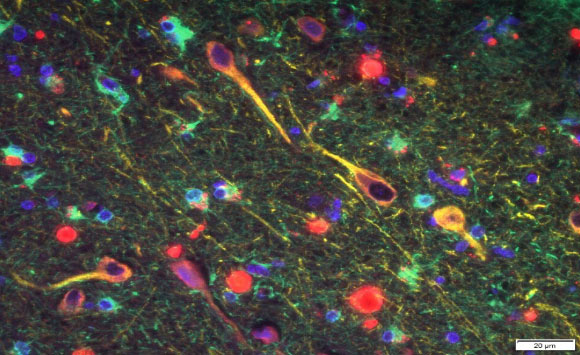 Porphyromonas gingivalis’ gingipains (red) among neurons in the brain of a patient with Alzheimer’s disease. Image credit: Cortexyme.