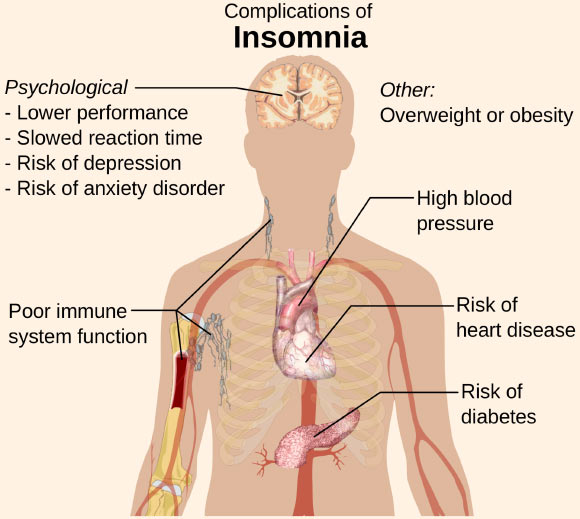 Lane et al identified 57 loci for self-reported insomnia symptoms in the UK Biobank (n = 453,379) and confirmed their effects on self-reported insomnia symptoms in the HUNT Study (n = 14,923 cases and 47,610 controls), physician-diagnosed insomnia in the Partners Biobank (n = 2,217 cases and 14,240 controls), and accelerometer-derived measures of sleep efficiency and sleep duration in the UK Biobank (n = 83,726). Image credit: Medical Gallery of Mikael Häggström, 2014 / WikiJournal of Medicine, doi: 10.15347/wjm/2014.008.