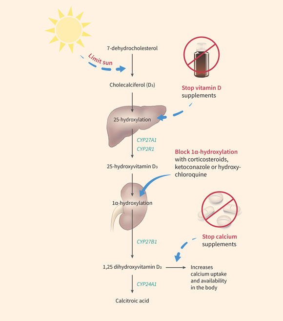 Simplified pathway of vitamin D metabolism with a suggested approach to manage hypervitaminosis D. Key steps include the following: limit sun exposure; stop oral vitamin D supplements; use medications such as corticosteroids, ketoconazole and hydroxychloroquine to block 1α-hydroxylase activity; stop oral calcium supplements to reduce burden of hypercalcemia from hypervitaminosis D. Key enzymes involved in metabolism pathway are shown in green. Image credit: Auguste et al, doi: 10.1503/cmaj.180465 / Creativology / BSG Studio.