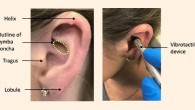 Site of application of vibrotactile device to the cymba concha of the ear. Left: major anatomical landmarks of the external ear (pinna) with approximate outline of the cymba concha; the cymba concha is a highly-conserved anatomical feature of the external ear that was identified by the device operator. Right: representative device placement of the vibrotactile device in contact with the cymba concha. Image credit: Addorisio et al, doi: 10.1186/s42234-019-0020-4.
