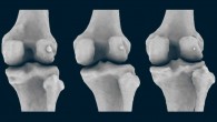 Large (left), medium (center), and small (right) fabellae (a small bone to the right of each image) in the right knees of three female subjects. Image credit: Berthaume et al, doi: 10.1111/joa.12994.