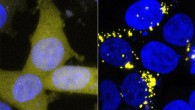 The normal form of amyloid beta has been tagged with a yellow marker in these cells, making healthy cells a uniform pale yellow (left). Contact with prion forms of amyloid beta -- for example in extracts from human brain tissue -- forces these yellow proteins into the sticky prion form as well, leading to the formation of bright yellow clumps (right). Image credit: Prusiner Lab / UCSF Institute for Neurodegenerative Diseases.
