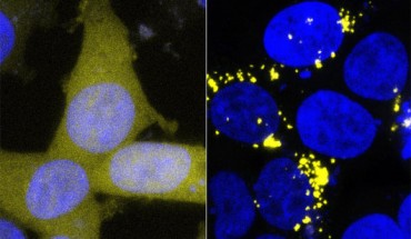 The normal form of amyloid beta has been tagged with a yellow marker in these cells, making healthy cells a uniform pale yellow (left). Contact with prion forms of amyloid beta -- for example in extracts from human brain tissue -- forces these yellow proteins into the sticky prion form as well, leading to the formation of bright yellow clumps (right). Image credit: Prusiner Lab / UCSF Institute for Neurodegenerative Diseases.