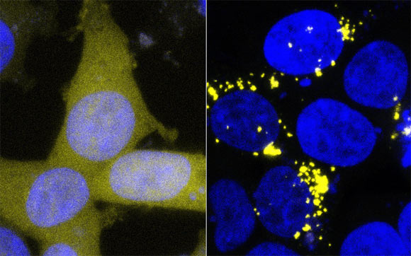 The normal form of amyloid beta has been tagged with a yellow marker in these cells, making healthy cells a uniform pale yellow (left). Contact with prion forms of amyloid beta -- for example in extracts from human brain tissue -- forces these yellow proteins into the sticky prion form as well, leading to the formation of bright yellow clumps (right). Image credit: Prusiner Lab / UCSF Institute for Neurodegenerative Diseases.