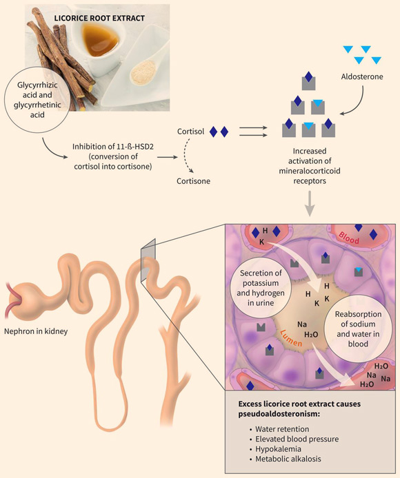 Demonstration of the main mechanism of action of licorice through inhibition of 11-β-hydroxysteroid dehydrogenase type 2 (11-β-HSD2) in the distal tubules of the kidney. H - hydrogen ion, H2O - water, K - potassium, Na - sodium. Image credit: Falet et al, doi: 10.1503/cmaj.180550.