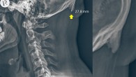 A radiograph of a 28-year-old male participant. Image credit: Shahar & Sayers, doi: 10.1038/s41598-018-21625-1.