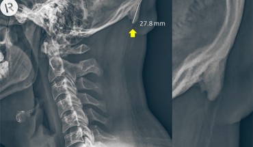 A radiograph of a 28-year-old male participant. Image credit: Shahar & Sayers, doi: 10.1038/s41598-018-21625-1.