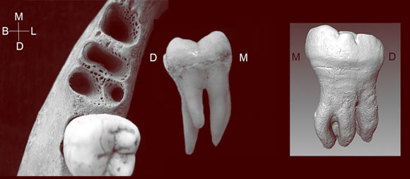 The 3-rooted lower first molar alveolar sockets showing distolingual position of accessory root and the 3-rooted lower first molar (lingual view). Inset: 3-rooted lower second molar of the Xiahe Denisovan individual (lingual view). M - mesial, L - lingual, D - distal, B - buccal. Image credit: Christine Lee, California State University / Bailey et al, doi: 10.1073/pnas.1907557116.