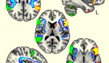 The language brain regions were more coordinated in left-handers between the two sides of the brain (in green and orange) and were also connected by the white matter tracts influenced by one genetic region related to handedness (in blue). Image credit: Gwenaëlle Douaud, University of Oxford.