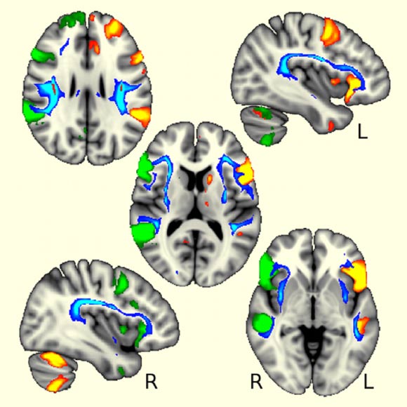 The language brain regions were more coordinated in left-handers between the two sides of the brain (in green and orange) and were also connected by the white matter tracts influenced by one genetic region related to handedness (in blue). Image credit: Gwenaëlle Douaud, University of Oxford.