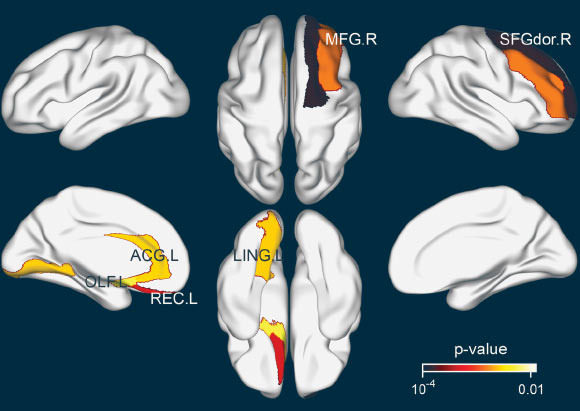 Brain regions exhibiting significant differences in structural nodal efficiency between the tea drinking group and the non-tea drinking group. Abbreviations: SFGdor.R - right superior frontal gyrus (dorsal), MFG.R - right middle frontal gyrus, OLF.L - left olfactory, REC.L - left gyrus rectus, ACG.L - left anterior cingulate and paracingulate gyri, LING.L - left lingual gyrus, which primarily reside in the frontal cortex. Image credit: Li et al, doi: 10.18632/aging.102023.