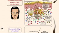 Model of dynamic interactions between the skin immune system (SIS) and its microbial/chemical milieu in human facial skin: (A) infancy -- before the development of stabilized microbial communities, an early tolerogenic interaction between the maturing SIS and the microbiota is prevalent; (B) after this initial period, a homeostatic crosstalk evolves between the developed SIS and a childhood-type stable microbiota; (C) adolescence -- enhanced sebum secretion and shift in the microbiota composition (and probably other uncovered events, e.g., barrier breach) might contribute to a dynamic change in the communication between the SIS and the microbiota in the skin, leading to inflammatory interactions; cytokines associated with a homeostatic dialog may become highly increased in acne lesions (relative to non-lesions), promoting inflammation together with newly secreted proinflammatory mediators produced by keratinocytes, dendritic cells (DCs), and subsequently, infiltrating inflammatory T helper (Th)1 and Th17(23) (for IL-23) cells, neutrophils, and macrophages; these mediators initiate follicular hyperkeratinization, closure of the follicular infundibulum, comedone formation, and the development of acne papules, pustules, and nodules; the extent and time course of inflammation can vary across a wide spectrum among teenagers; (D) following the resolution of acne, in adult SGR skin, under steady-state, SIS and region-specific microbes carry on a homeostatic dialog with the microbiota again, mediated by the controlled production of innate immune-cell-derived factors, including complement components, AMPs, IL-1, TSLP, and IL-7; hair follicles may play a pivotal role in this crosstalk, supporting the residency and recruitment of LCs, Tregs, ILCs, as well as nonpathogenic Th17(β) cells to maintain homeostasis; upward arrows depict increases (expression, concentrations, and ratios). Propionibacterium acnes (Propionibacteriaceae) = Cutibacterium acnes. Other relevant bacterial genera are noted in the schematic. Abbreviations: AMP - antimicrobial peptide, IL – interleukin, ILC - innate lymphoid cell, LC - Langerhans cell, mDC - myeloid dendritic cell, RORγt - RAR-related orphan receptor γt, SGR - sebaceous gland rich, SIS - skin immune system, TGF - transforming growth factor, Th - T helper, Treg - regulatory T cell, TSLP - thymic stromal lymphopoietin. Image credit: Szegedi et al, doi: 10.1016/j.it.2019.08.006.