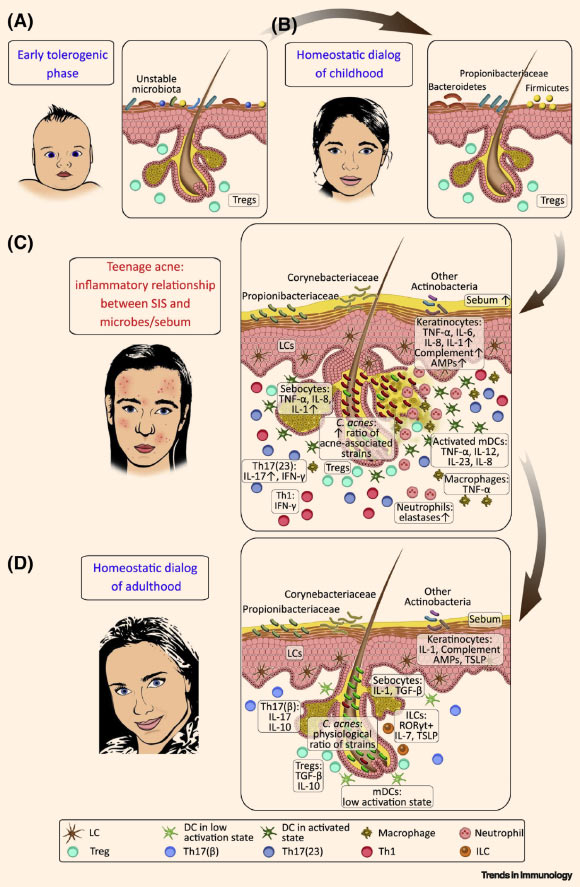 Model of dynamic interactions between the skin immune system (SIS) and its microbial/chemical milieu in human facial skin: (A) infancy -- before the development of stabilized microbial communities, an early tolerogenic interaction between the maturing SIS and the microbiota is prevalent; (B) after this initial period, a homeostatic crosstalk evolves between the developed SIS and a childhood-type stable microbiota; (C) adolescence -- enhanced sebum secretion and shift in the microbiota composition (and probably other uncovered events, e.g., barrier breach) might contribute to a dynamic change in the communication between the SIS and the microbiota in the skin, leading to inflammatory interactions; cytokines associated with a homeostatic dialog may become highly increased in acne lesions (relative to non-lesions), promoting inflammation together with newly secreted proinflammatory mediators produced by keratinocytes, dendritic cells (DCs), and subsequently, infiltrating inflammatory T helper (Th)1 and Th17(23) (for IL-23) cells, neutrophils, and macrophages; these mediators initiate follicular hyperkeratinization, closure of the follicular infundibulum, comedone formation, and the development of acne papules, pustules, and nodules; the extent and time course of inflammation can vary across a wide spectrum among teenagers; (D) following the resolution of acne, in adult SGR skin, under steady-state, SIS and region-specific microbes carry on a homeostatic dialog with the microbiota again, mediated by the controlled production of innate immune-cell-derived factors, including complement components, AMPs, IL-1, TSLP, and IL-7; hair follicles may play a pivotal role in this crosstalk, supporting the residency and recruitment of LCs, Tregs, ILCs, as well as nonpathogenic Th17(β) cells to maintain homeostasis; upward arrows depict increases (expression, concentrations, and ratios). Propionibacterium acnes (Propionibacteriaceae) = Cutibacterium acnes. Other relevant bacterial genera are noted in the schematic. Abbreviations: AMP - antimicrobial peptide, IL – interleukin, ILC - innate lymphoid cell, LC - Langerhans cell, mDC - myeloid dendritic cell, RORγt - RAR-related orphan receptor γt, SGR - sebaceous gland rich, SIS - skin immune system, TGF - transforming growth factor, Th - T helper, Treg - regulatory T cell, TSLP - thymic stromal lymphopoietin. Image credit: Szegedi et al, doi: 10.1016/j.it.2019.08.006.