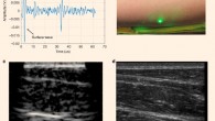 Conventional ultrasound verifies soft- and hard-tissue features detected in laser ultrasound (LUS) imaging on the forearm: (a) single time trace from LUS imaging of a volunteer’s forearm; (b) photograph of a volunteer’s forearm region, imaged using LUS and conventional ultrasound; a green tracking laser from the LDV is also visible; (c) reconstructed LUS image of a volunteer’s forearm with multiple visible tissue layers; (d) matching conventional ultrasound image of the volunteer’s forearm using a GE Logiq E9 system and a 9 MHz linear probe confirming features detected in the LUS image. Image credit: Zhang et al, doi: 10.1038/s41377-019-0229-8.