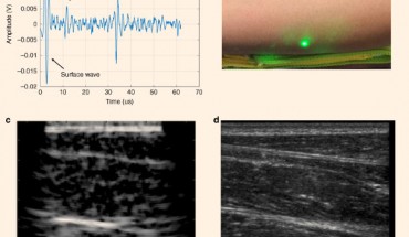 Conventional ultrasound verifies soft- and hard-tissue features detected in laser ultrasound (LUS) imaging on the forearm: (a) single time trace from LUS imaging of a volunteer’s forearm; (b) photograph of a volunteer’s forearm region, imaged using LUS and conventional ultrasound; a green tracking laser from the LDV is also visible; (c) reconstructed LUS image of a volunteer’s forearm with multiple visible tissue layers; (d) matching conventional ultrasound image of the volunteer’s forearm using a GE Logiq E9 system and a 9 MHz linear probe confirming features detected in the LUS image. Image credit: Zhang et al, doi: 10.1038/s41377-019-0229-8.