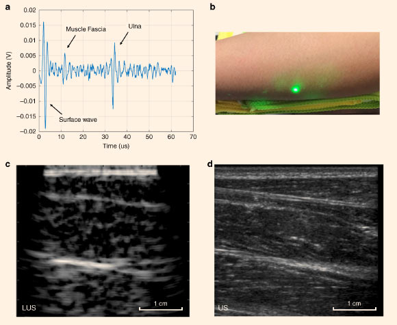 Conventional ultrasound verifies soft- and hard-tissue features detected in laser ultrasound (LUS) imaging on the forearm: (a) single time trace from LUS imaging of a volunteer’s forearm; (b) photograph of a volunteer’s forearm region, imaged using LUS and conventional ultrasound; a green tracking laser from the LDV is also visible; (c) reconstructed LUS image of a volunteer’s forearm with multiple visible tissue layers; (d) matching conventional ultrasound image of the volunteer’s forearm using a GE Logiq E9 system and a 9 MHz linear probe confirming features detected in the LUS image. Image credit: Zhang et al, doi: 10.1038/s41377-019-0229-8.