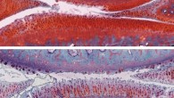 The top image shows a knee joint in a healthy rat (white indicates cartilage); the second image from top shows a joint with grade 2 untreated osteoarthritis; the third image shows a joint with osteoarthritis that has worsened from grade 2 to grade 4 after six weeks of placebo therapy; the bottom image shows a joint with osteoarthritis that improved from grade 2 to grade 1 (mild) after six weeks of combination therapy with αKLOTHO and TGFβR2. Image credit: Salk Institute.