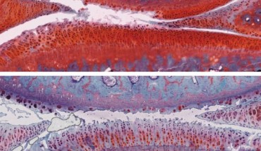 The top image shows a knee joint in a healthy rat (white indicates cartilage); the second image from top shows a joint with grade 2 untreated osteoarthritis; the third image shows a joint with osteoarthritis that has worsened from grade 2 to grade 4 after six weeks of placebo therapy; the bottom image shows a joint with osteoarthritis that improved from grade 2 to grade 1 (mild) after six weeks of combination therapy with αKLOTHO and TGFβR2. Image credit: Salk Institute.
