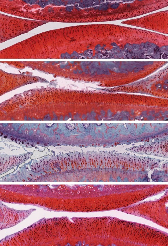 The top image shows a knee joint in a healthy rat (white indicates cartilage); the second image from top shows a joint with grade 2 untreated osteoarthritis; the third image shows a joint with osteoarthritis that has worsened from grade 2 to grade 4 after six weeks of placebo therapy; the bottom image shows a joint with osteoarthritis that improved from grade 2 to grade 1 (mild) after six weeks of combination therapy with αKLOTHO and TGFβR2. Image credit: Salk Institute.