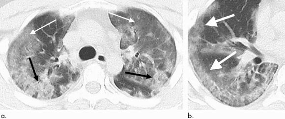 29-year old male with unknown exposure history, presenting with fever and cough, ultimately requiring intensive care unit admission: (a) axial thin-section non-contrast CT scan shows diffuse bilateral confluent and patchy ground-glass (solid arrows) and consolidative (dashed arrows) pulmonary opacities; (b) the disease in the right middle and lower lobes has a striking peripheral distribution (arrow). Image credit: Chung et al, doi: 10.1148/radiol.2020200230.
