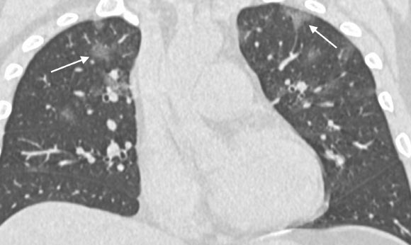 36-year old male with history of recent travel to Wuhan, presenting with fever, fatigue and myalgias. Coronal thin-section non-contrast CT image shows ground-glass opacities with a rounded morphology in both upper lobes (arrows). Image credit: Chung et al, doi: 10.1148/radiol.2020200230.
