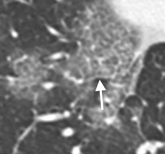 66-year old female with history of recent travel to Wuhan, presenting with fever and productive cough. Axial thin-section coned-down non-contrast CT image shows a ‘crazy paving’ pattern as manifested by right lower lobe ground-glass opacification and interlobular septal thickening (arrow) with intralobular lines. Image credit: Chung et al, doi: 10.1148/radiol.2020200230.