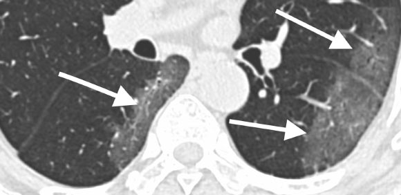 69-year old male with history of recent travel to Wuhan, presenting with fever. Axial thin-section non-contrast CT scan shows ground-glass opacities in the lower lobes with a pronounced peripheral distribution (arrows). Image credit: Chung et al, doi: 10.1148/radiol.2020200230.
