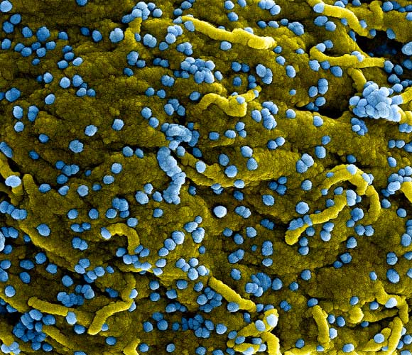 de Wit et al show that remdesivir is a promising antiviral treatment against MERS that could be considered for implementation in clinical trials. This colorized scanning electron micrograph shows MERS virus particles (blue) both budding and attached to the surface of infected VERO E6 cells (yellow). Image credit: NIAID.