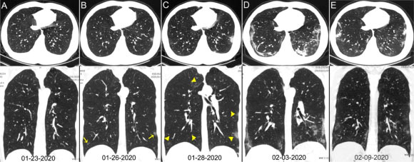 Chest CT images of a 29-year-old man with fever for 6 days; RT-PCR assay for the SARS-CoV-2 using a swab sample was performed on February 5, 2020, with a positive result: (A) normal chest CT with axial and coronal planes was obtained at the onset; (B) chest CT with axial and coronal planes shows minimal ground-glass opacities in the bilateral lower lung lobes (yellow arrows); (C) chest CT with axial and coronal planes shows increased ground-glass opacities (yellow arrowheads); (D) chest CT with axial and coronal planes shows the progression of pneumonia with mixed ground-glass opacities and linear opacities in the subpleural area; (E) chest CT with axial and coronal planes shows the absorption of both ground-glass opacities and organizing pneumonia. Image credit: Ai et al, doi: 10.1148/radiol.2020200642.