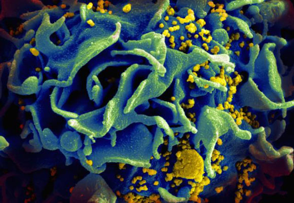 Scanning electromicrograph of an HIV-infected T cell. Image credit: NIAID.