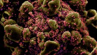 Colorized scanning electron micrograph of an apoptotic cell (greenish brown) heavily infected with SARS-COV-2 virus particles (pink), isolated from a patient sample. Image credit: NIAID.